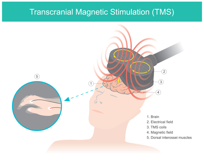TMS therapy session